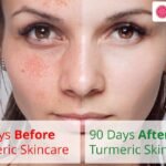 Benefits of Turmeric for Skin